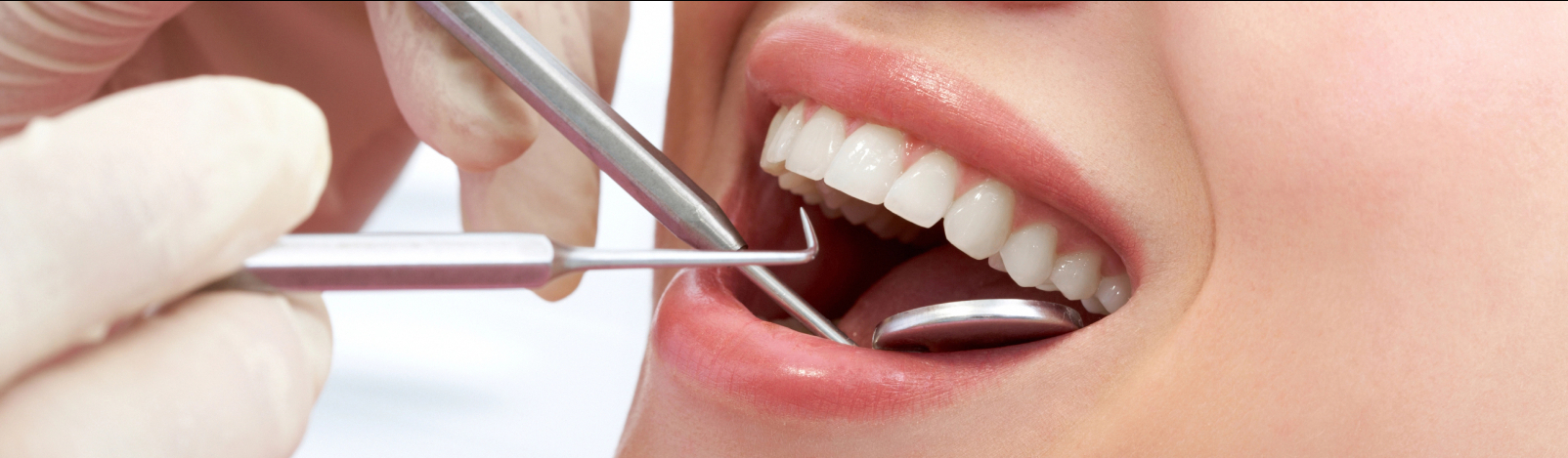 Dental Fillings: The Benefit of Detecting Tooth Decay Early