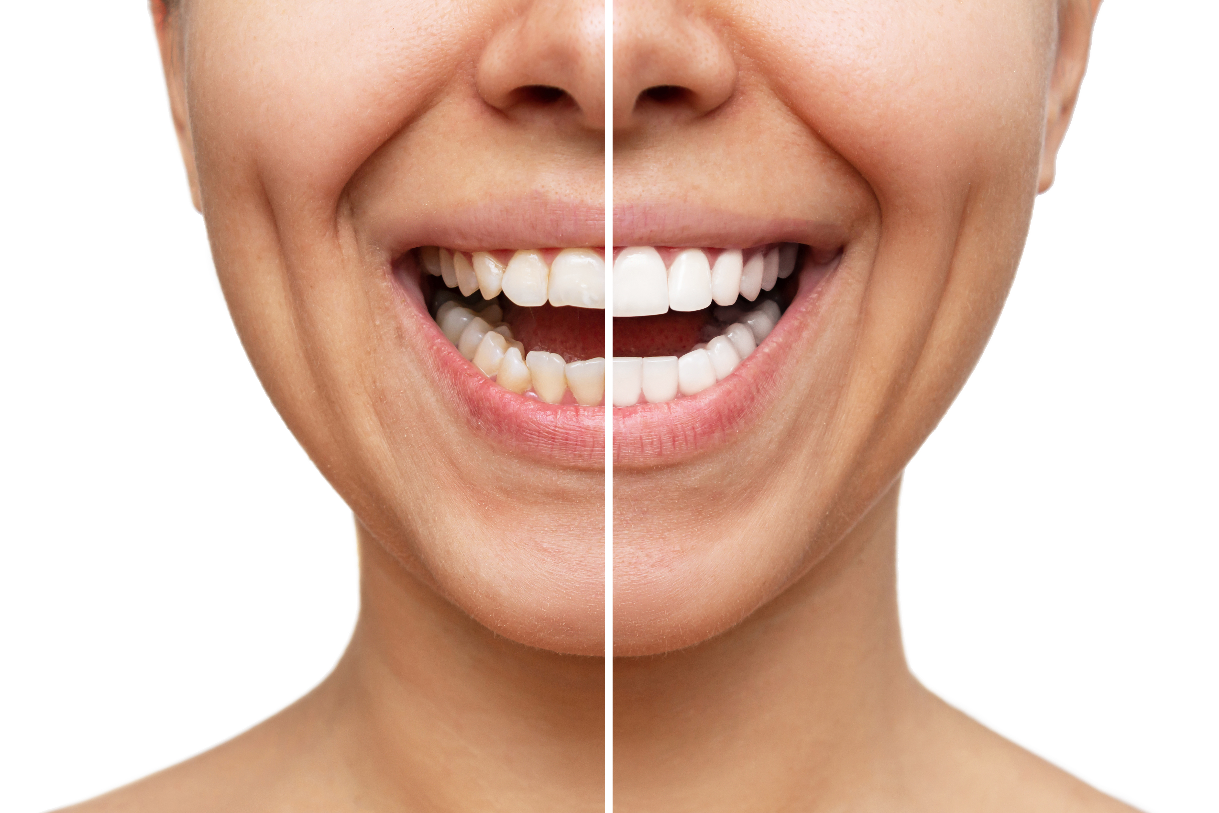 Betoverende glimlachen met composiet bonding fineer in Turkije: een uitgebreide tandheelkundige ervaring in het Ozdemir Dental Center