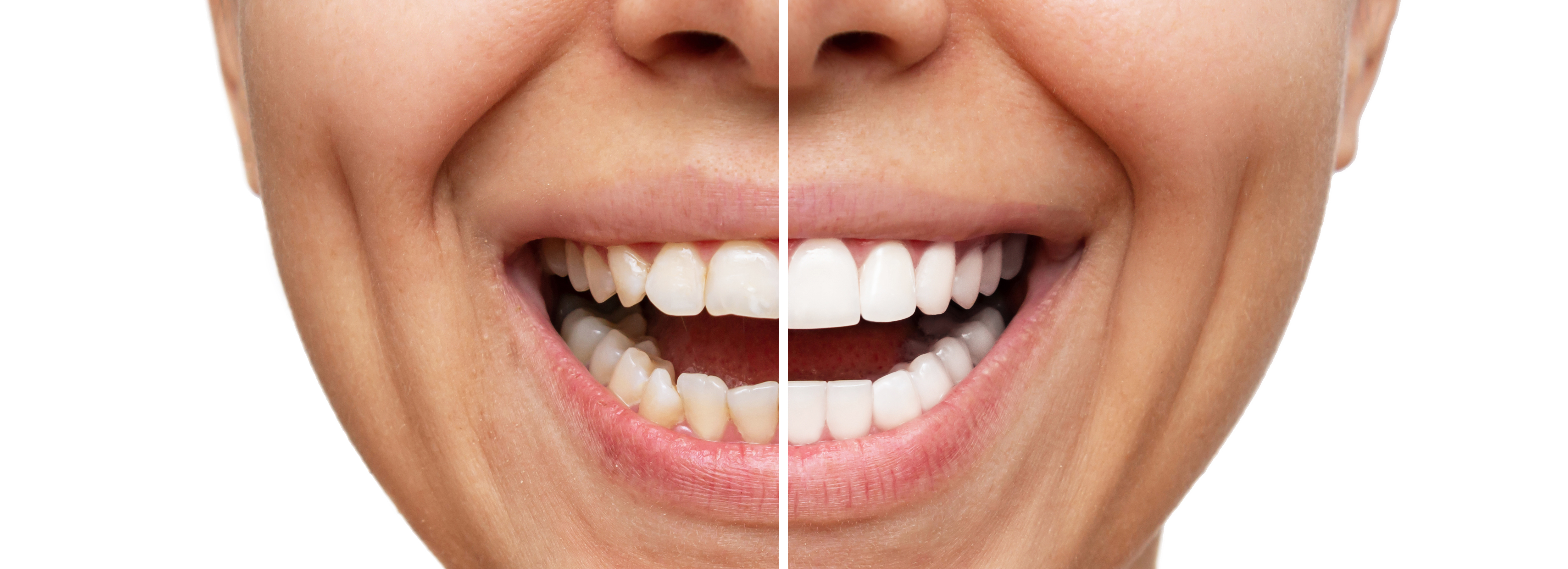 Betoverende glimlachen met composiet bonding fineer in Turkije: een uitgebreide tandheelkundige ervaring in het Ozdemir Dental Center